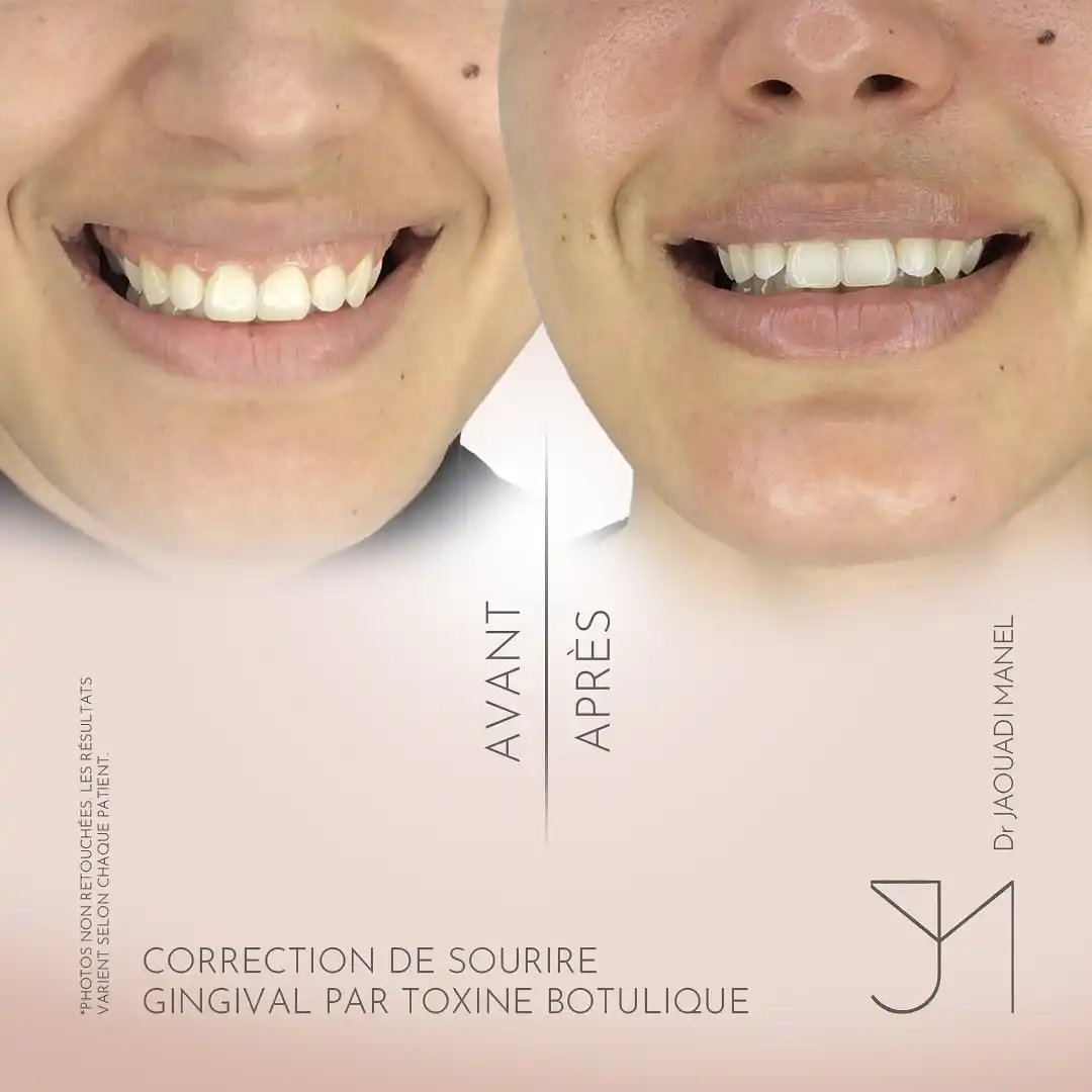 Correction du sourire gingival