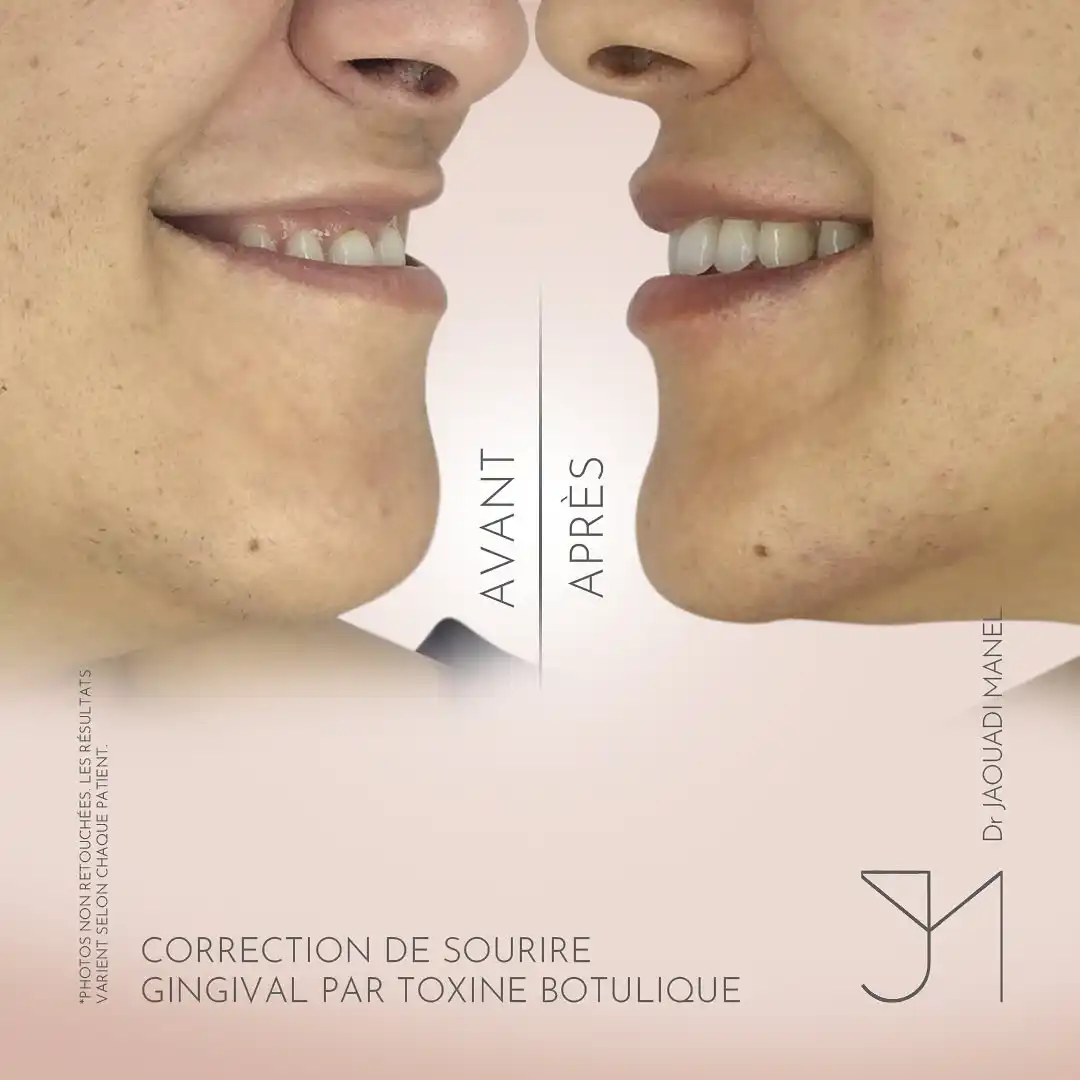 Correction du sourire gingival1