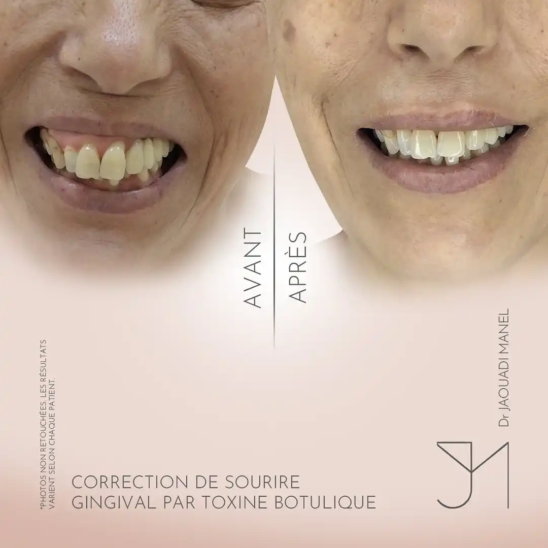 Correction du sourire gingival2