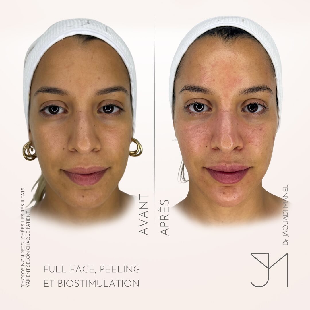 Full face sur visage fin - relief retrouvé, signature subtile et précise. Rafraîchissez votre vi