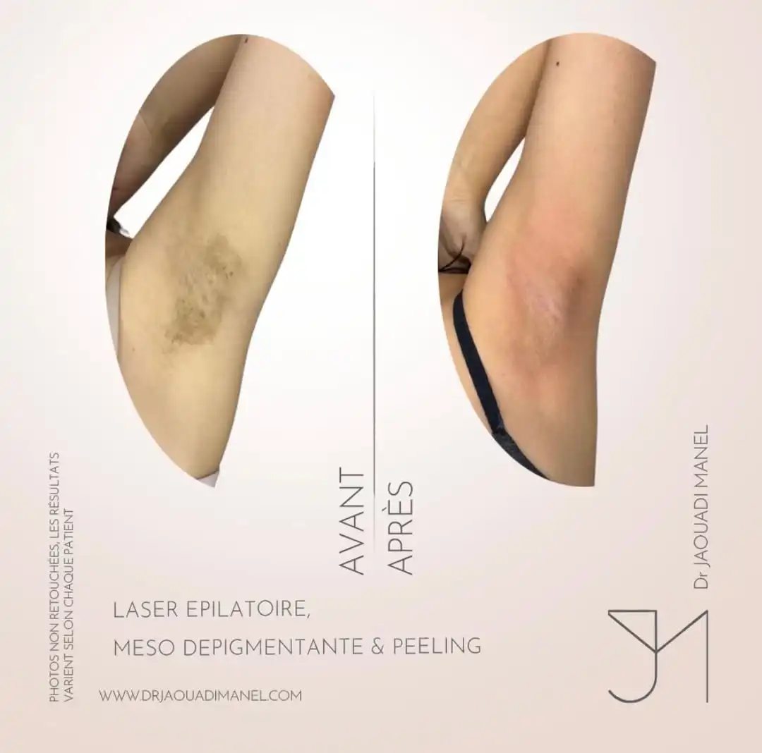 Hyperpigmentation des aisselles -la solution n’est jamais un seul traitement.Peeling pour renouv