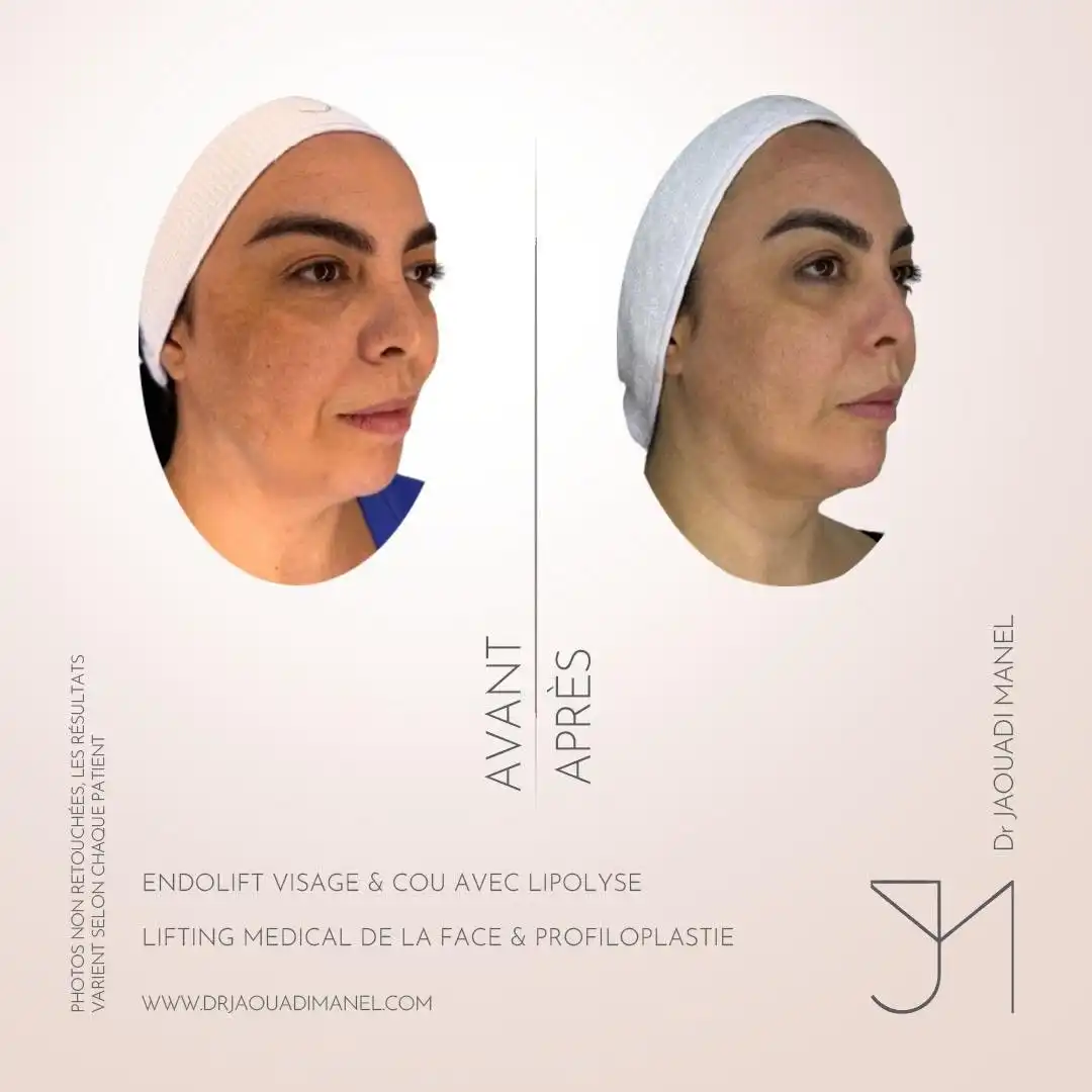 Un détail anatomique maîtrisé peut transformer l’harmonie d’un visage. Osez le changement ✨ (1)