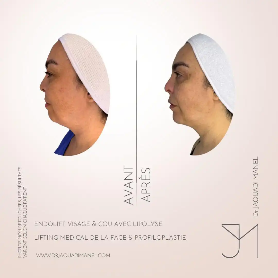 Un détail anatomique maîtrisé peut transformer l’harmonie d’un visage. Osez le changement ✨ (2)