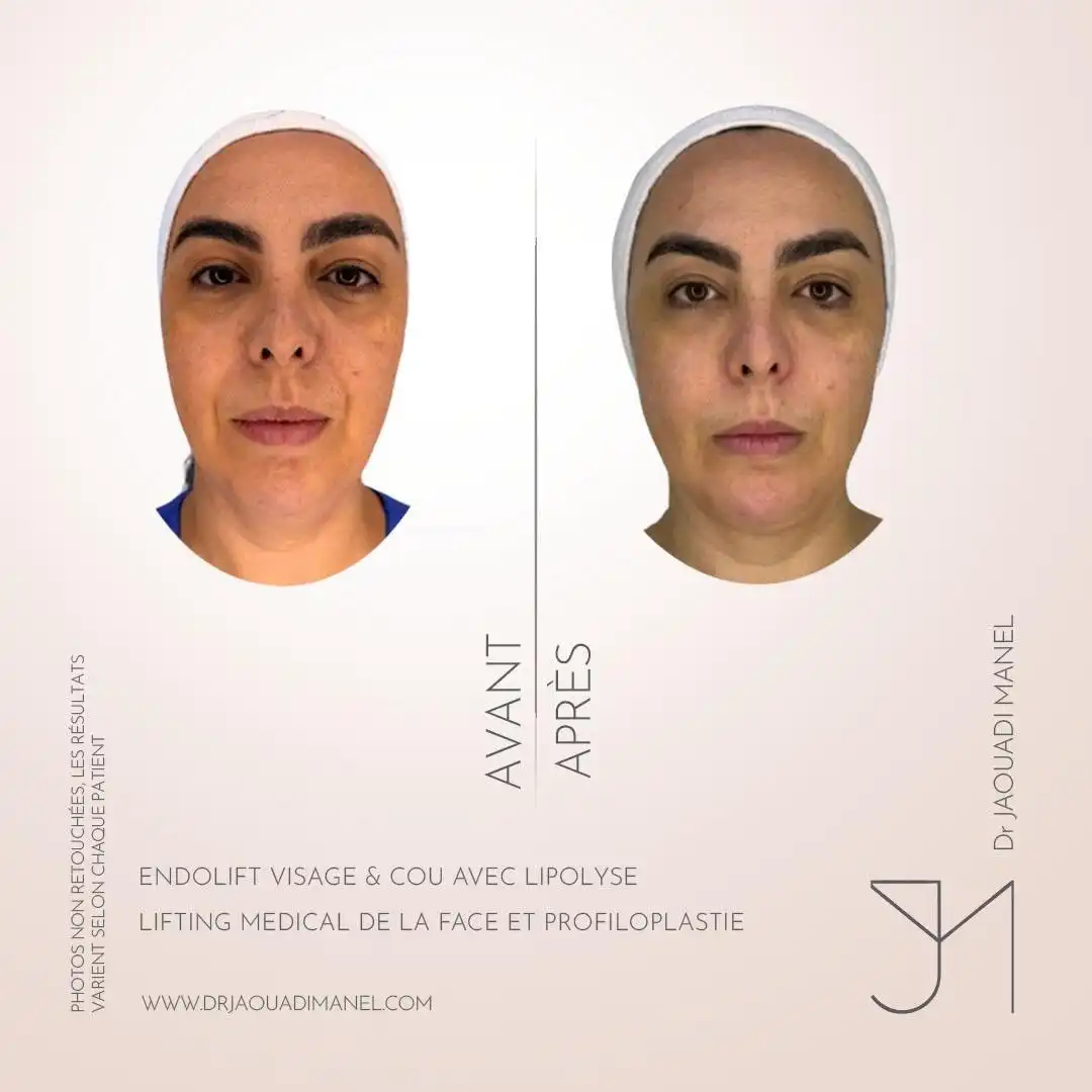 Un détail anatomique maîtrisé peut transformer l’harmonie d’un visage. Osez le changement ✨