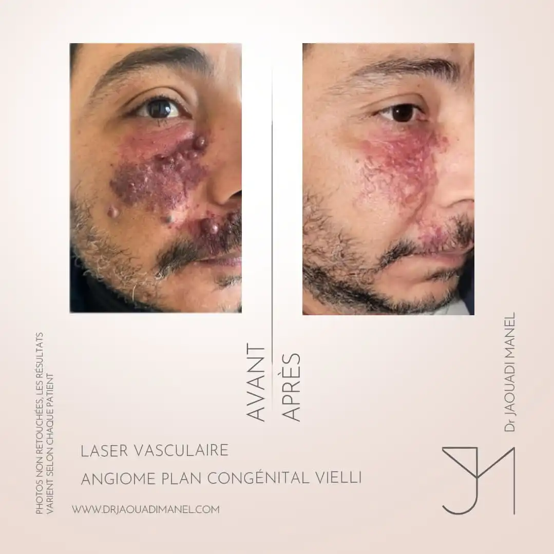 laser vasculaire