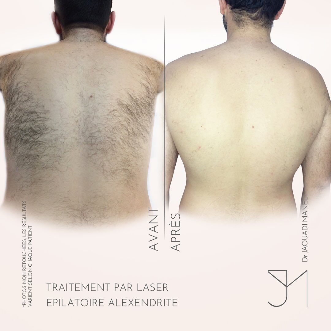 Chez l’homme, les zones les plus traitées sont - dos, torse, barbe et nuque.Résultat - diminutio