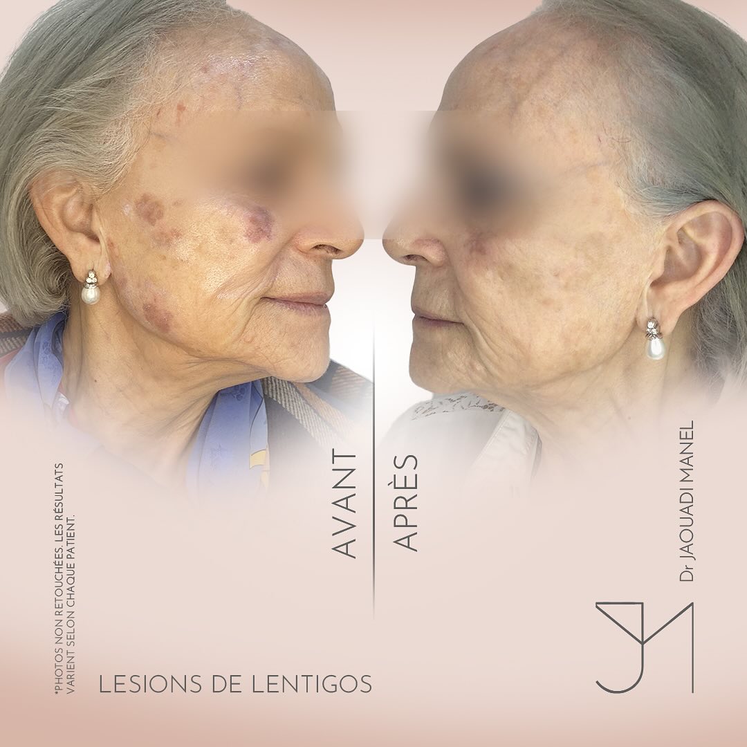 🌞 Les lentigos solaires - pas une fatalité !⚡️Grâce au laser pigmentaire, le teint est unifié,