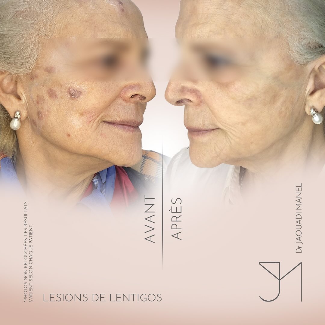 🌞 Les lentigos solaires - pas une fatalité !⚡️Grâce au laser pigmentaire, le teint est unifié, (1)