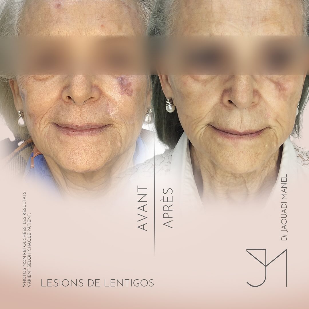 🌞 Les lentigos solaires - pas une fatalité !⚡️Le laser pigmentaire unifie le teint, illumine la