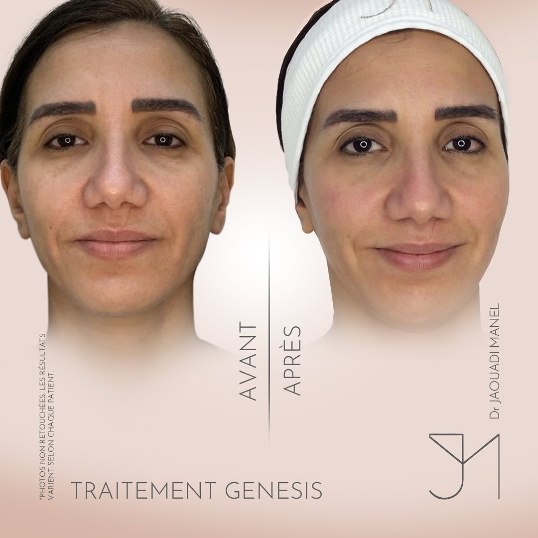 🔬 Laser Genesis - une peau qui s’exprime naturellement 🌿Teint unifié, pores resserrés, rougeur